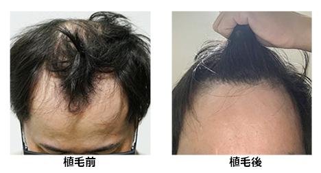 生え際 M字植毛 2,000株